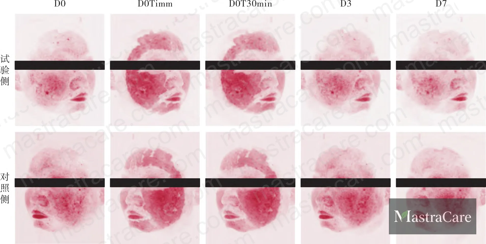 Figure 4: VISIA imaging comparison of test vs. control facial sides showing visible redness reduction over 7 days