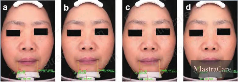 Figure 1: Multi-zone wrinkle area and volume reduction data across cheek, glabellar, under-eye, nasolabial fold, outer canthus, and mouth corner sites after 14, 28, and 56 days of daily use with 0.1% PUR10 cream