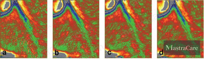 Figure 2: Progressive improvement in chin angle (52-year-old volunteer, D0 to D56) and nasolabial fold depth (49-year-old female volunteer, D0 to D56) with daily application of 0.1% PUR10 cream