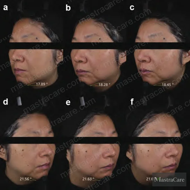 Figure 4: Mandibular angle improvement in 49-year-old volunteer — treatment side (D0, D14, D28) vs. control side, demonstrating superior jawline definition with 0.1% PUR10 cream